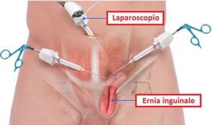 ernia inguinale
