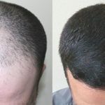 trapianto-capelli-turchia