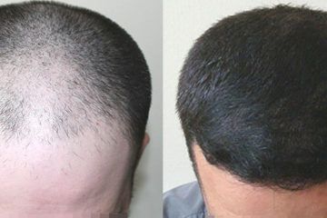 trapianto-capelli-turchia